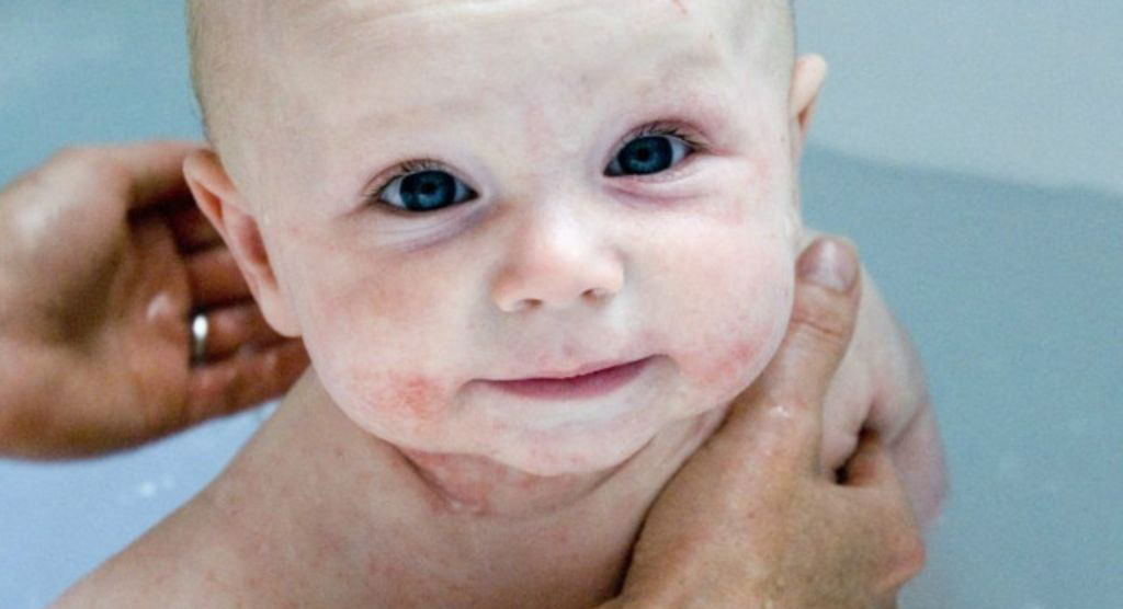 Infant Eczema Research