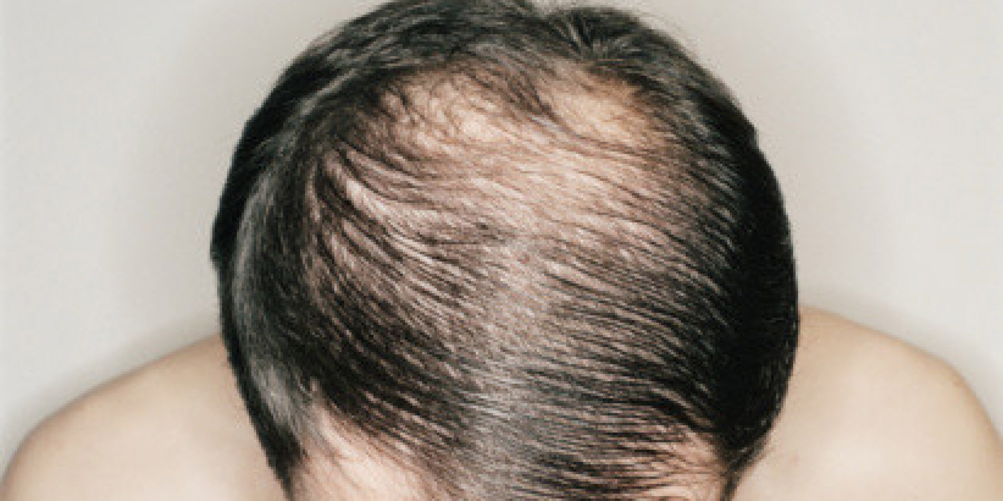 Hair Loss Due To Iron Deficiency