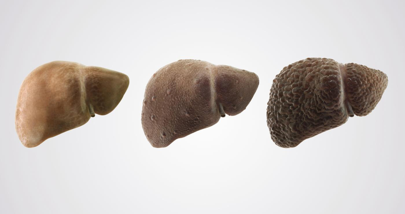 Autoimmune Liver Disease Symptoms