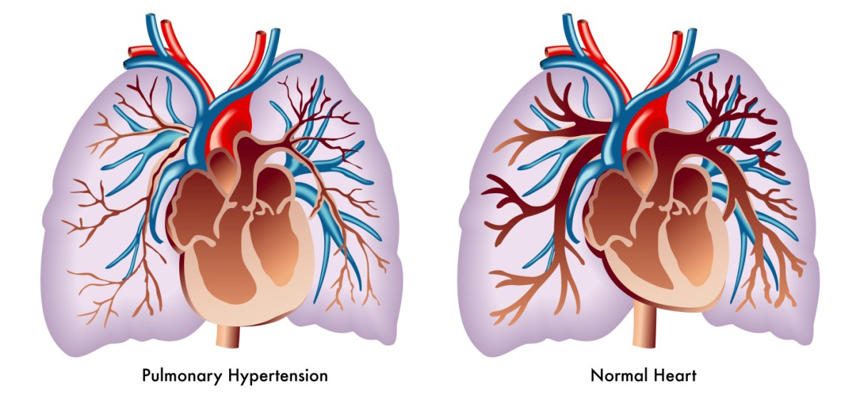 Useful Facts about Pulmonary Heart Disease